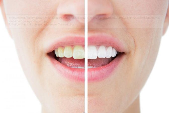 You are currently viewing 5 Facts You Should Know About Teeth Whitening