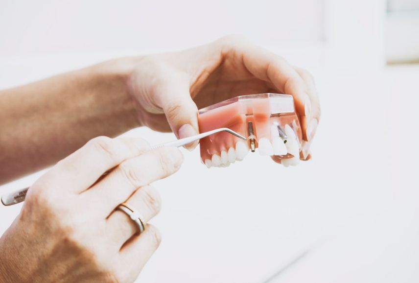 You are currently viewing Dental Implants Procedure and Recovery