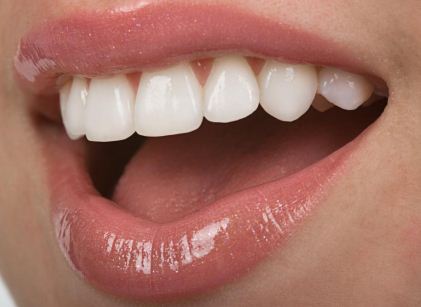 Read more about the article 4 Most Common Mistakes When Getting Veneers