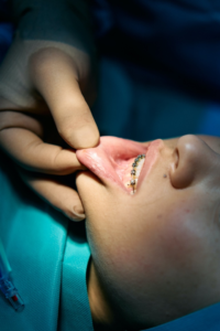 A patient getting metal braces