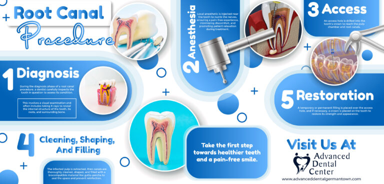 Read more about the article Root Canal Procedure – Infographic