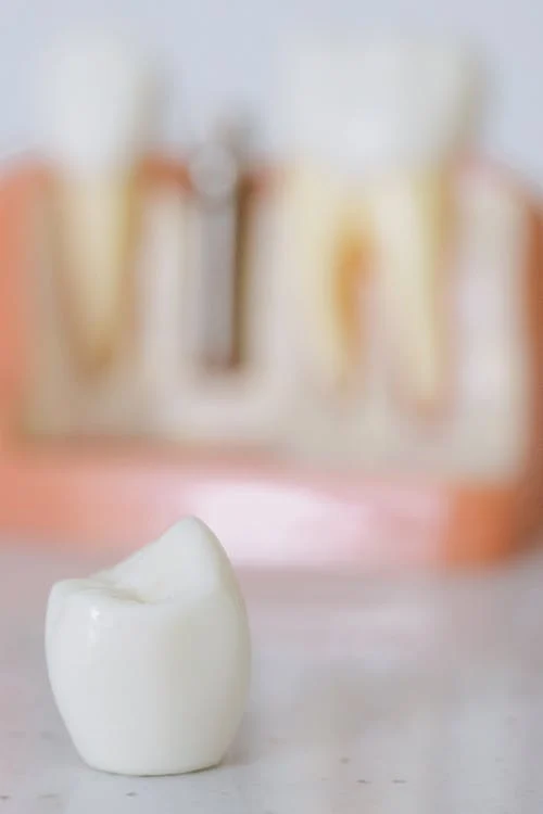 An image of a tooth implant
