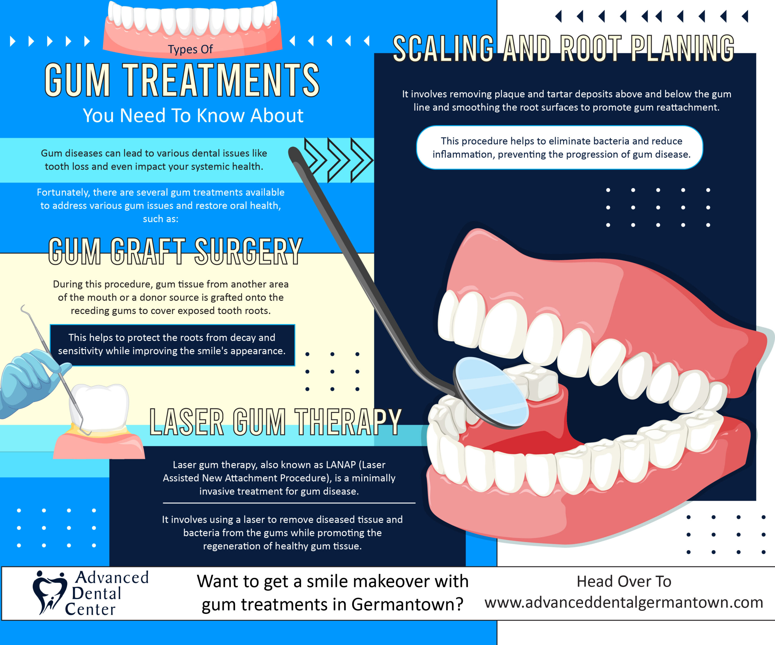 You are currently viewing Types of Gum Treatments you need to know about – Infographic