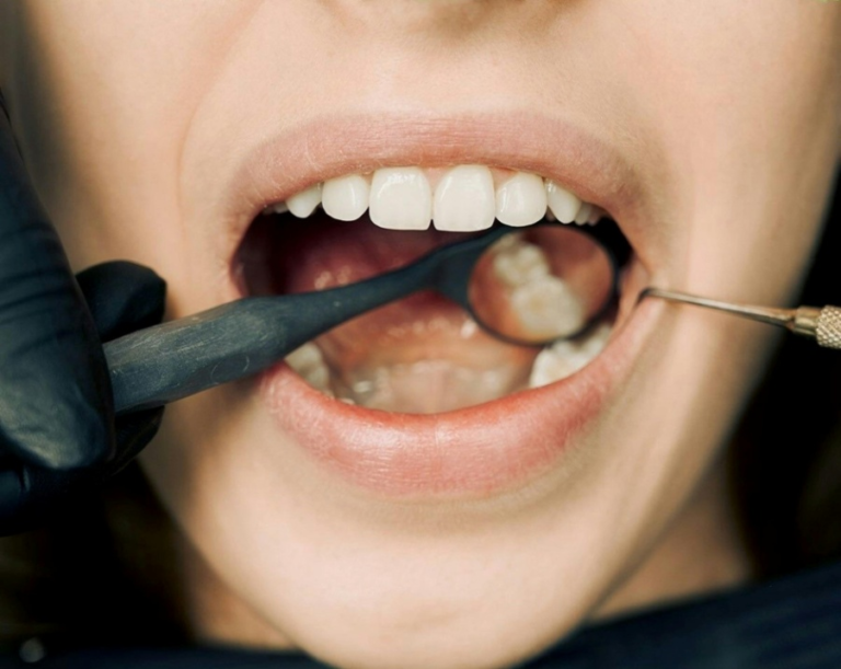 Read more about the article Understanding the Causes and Treatments for Receding Gums