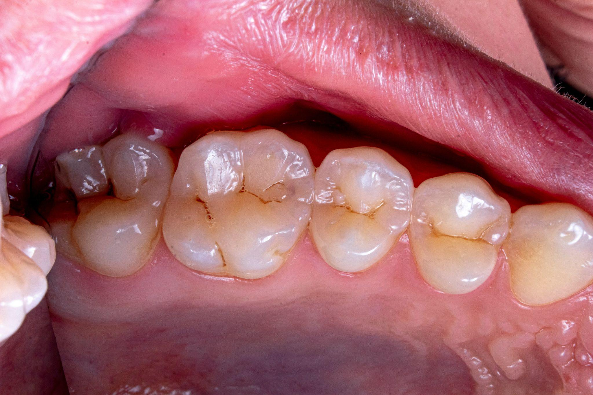 A set of teeth showing an early sign of tooth cavity