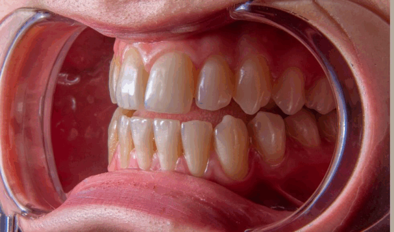 Read more about the article Periodontal Maintenance: The Key to Long-Term Gum Health