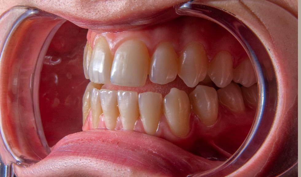 Read more about the article Periodontal Maintenance: The Key to Long-Term Gum Health