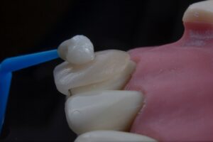 Close-up of teeth during dental procedure