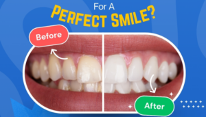 Smile Makeovers: What Options Are Available For A Perfect Smile?