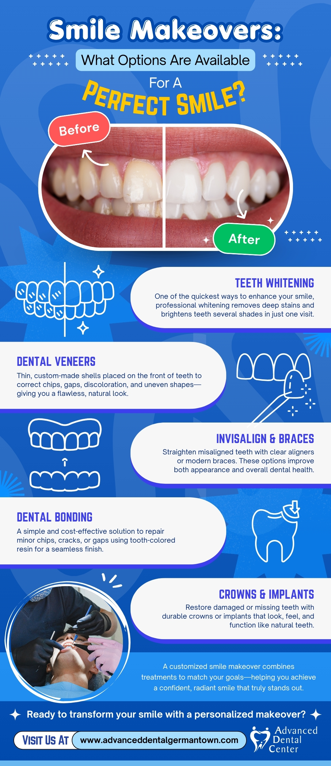 Smile Makeovers: What Options Are Available For A Perfect Smile?
