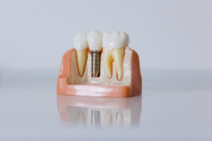 A detailed dental implant model showcasing the tooth structure for educational purposes