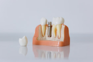 a cross-section model of a dental implant post next to a crown