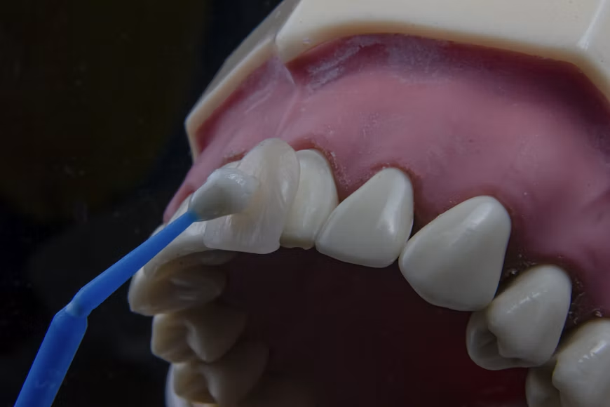 A dental model demonstrates the application of a blue instrument to an artificial tooth