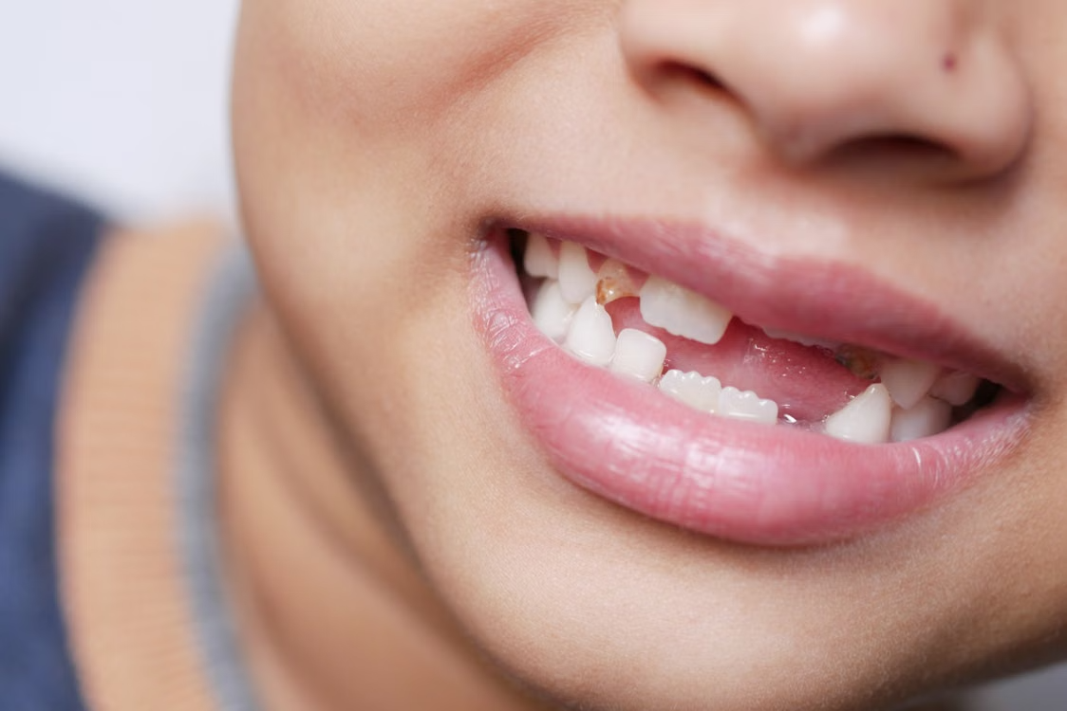 Read more about the article How Missing Teeth Can Affect More Than Your Smile